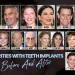 Celebrities With Teeth Implants Before And After kapak