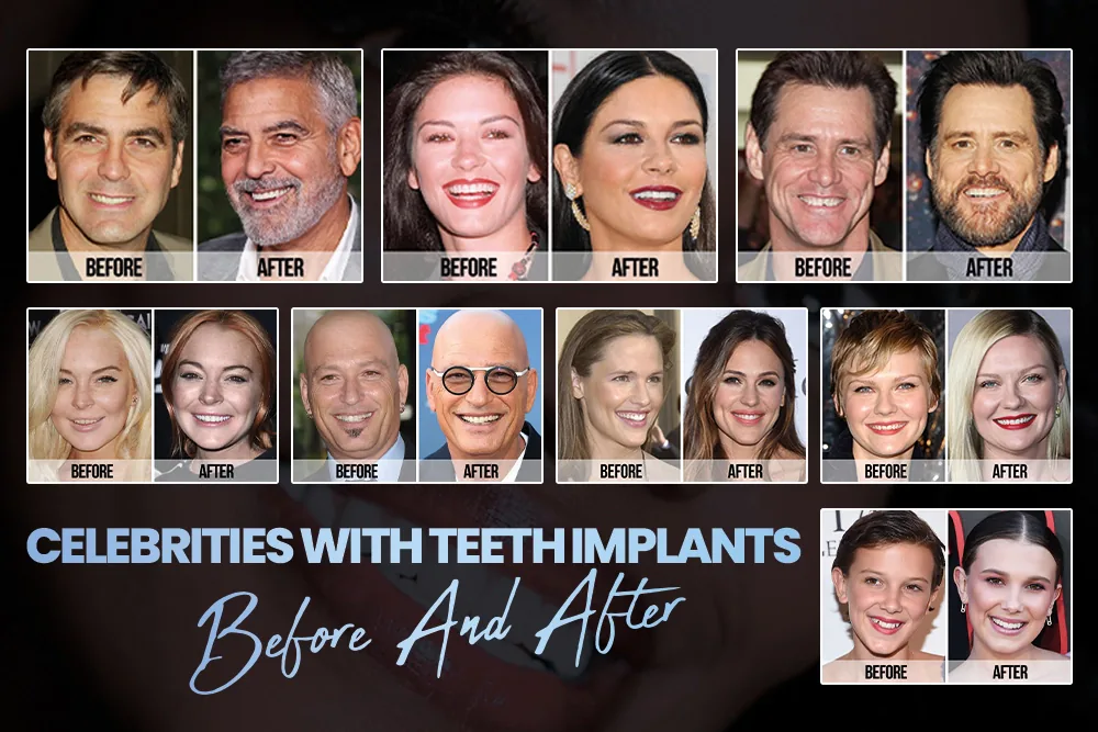 Celebrities With Teeth Implants Before And After