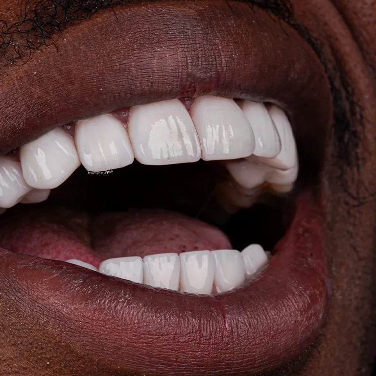 Does a Hollywood Smile Make You Look Younger