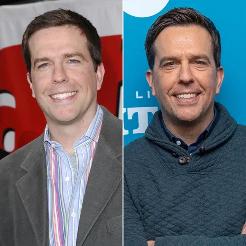Ed Helms Hairline Restoration