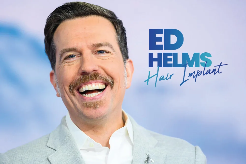 Ed Helms Hair Implant