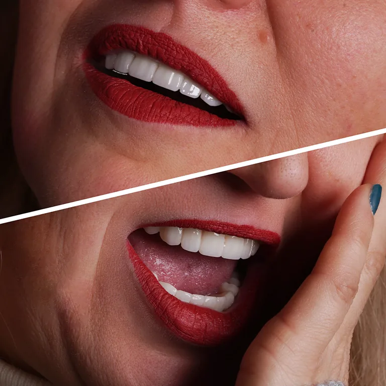 Hollywood Smile Makeover How Celebrities Achieve Perfect Teeth