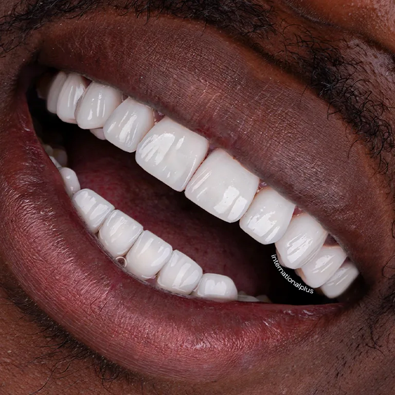 How to Improve Your Smile Aesthetics Without Surgery