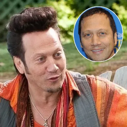 Rob Schneider Before and After Hair Transplant
