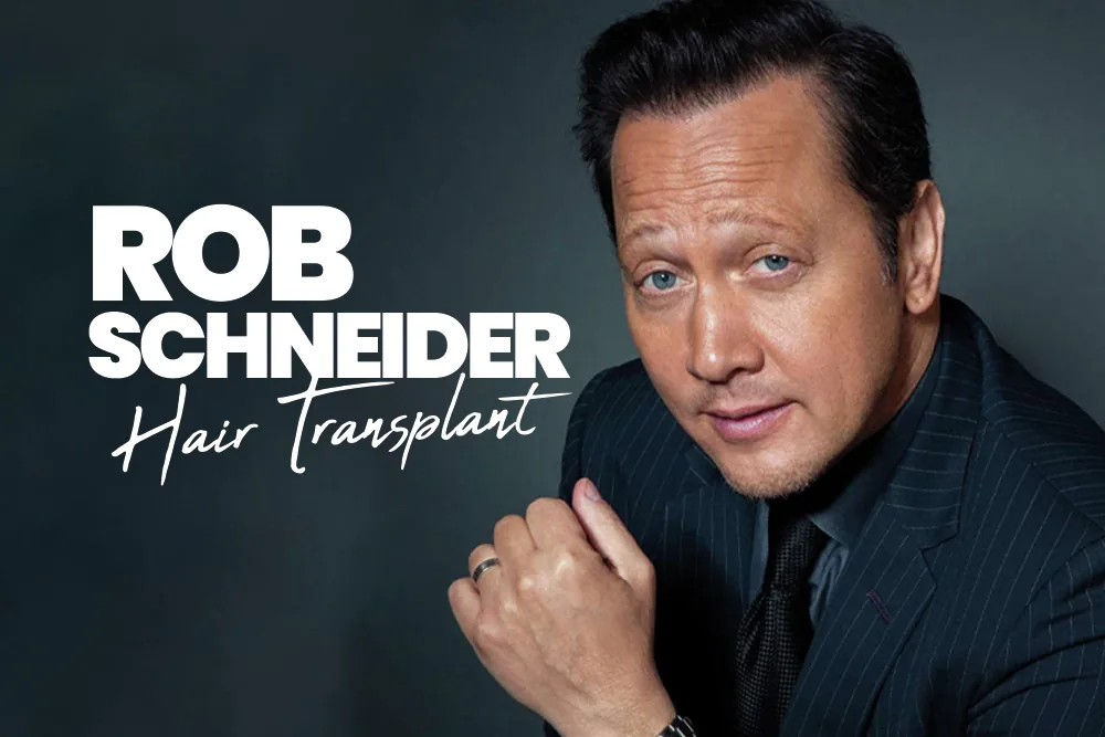 Rob Schneider Hair Transplant
