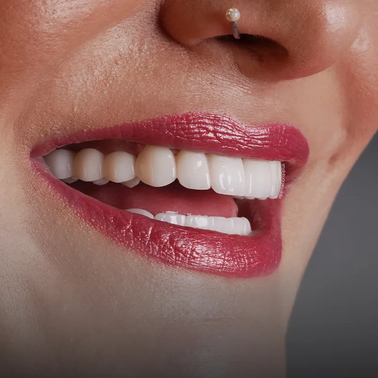 Teeth Whitening for Smile Aesthetics