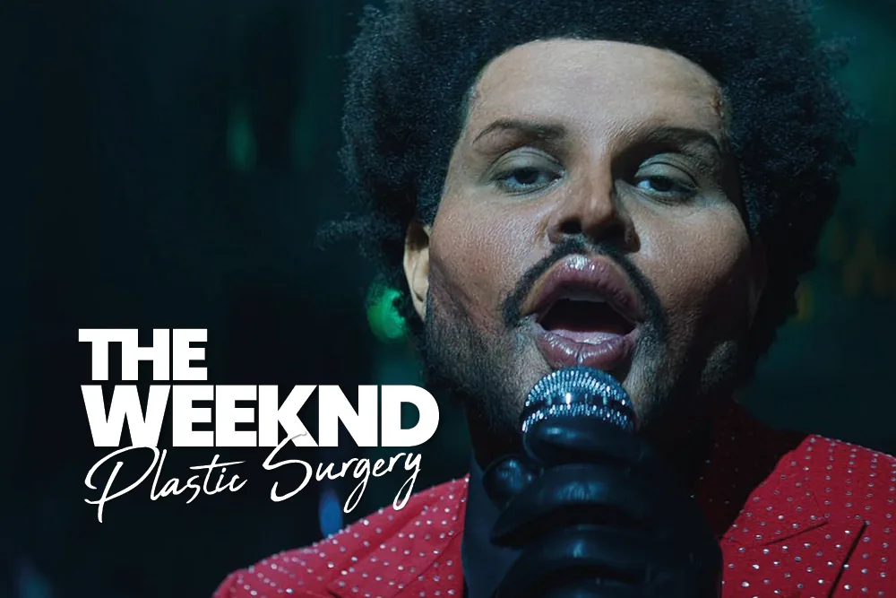 The Weeknd Plastic Surgery