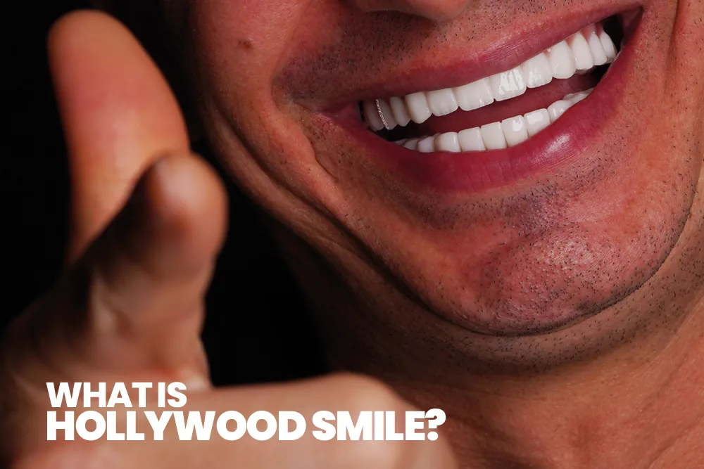What is Hollywood Smile?