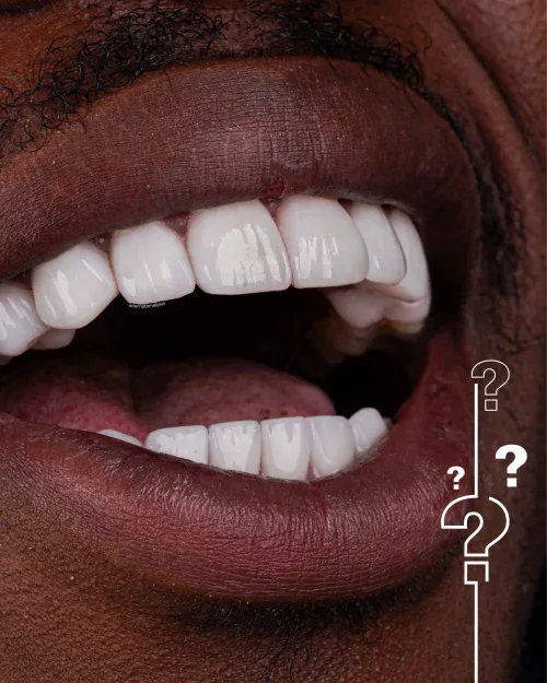 What Is a Hollywood Smile?