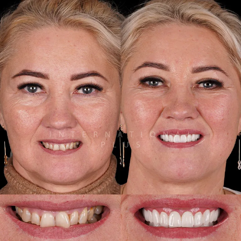Why Choose Turkey for Affordable Dental Treatments