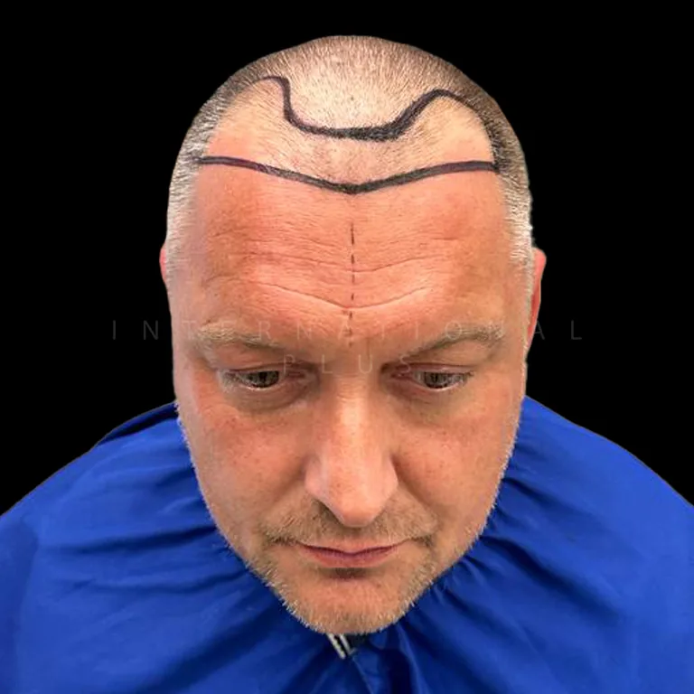 All Treatments Before After 13