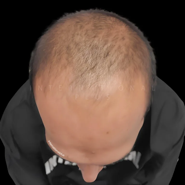 All Treatments Before After 15