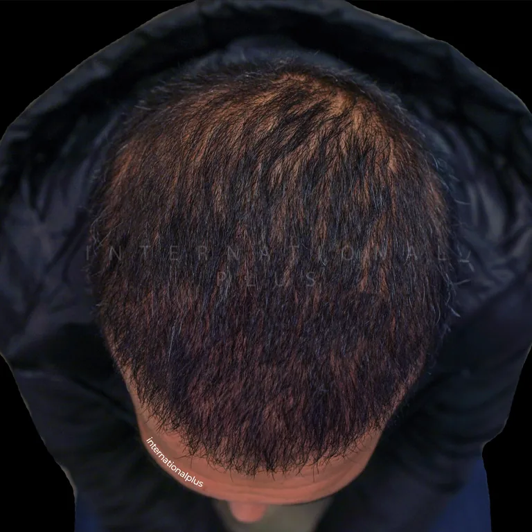 All Treatments Before After 16