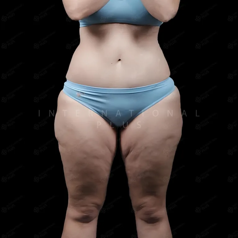 All Treatments Before After 17