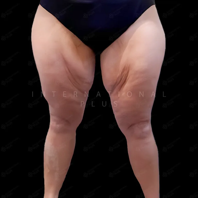 All Treatments Before After 19