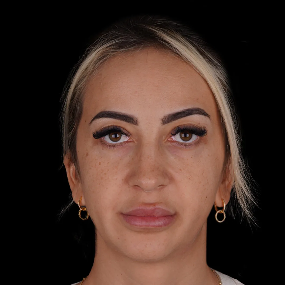 All Treatments Before After 29