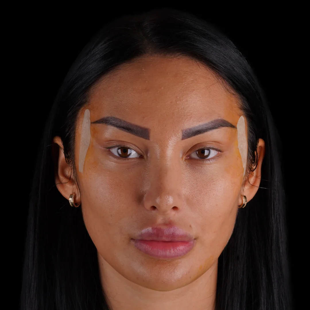 All Treatments Before After 32