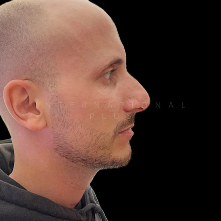 All Treatments Before After 35