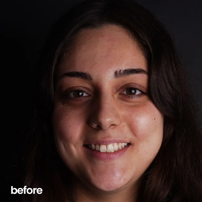 Hollywood Smile vs. Veneers What’s the Difference