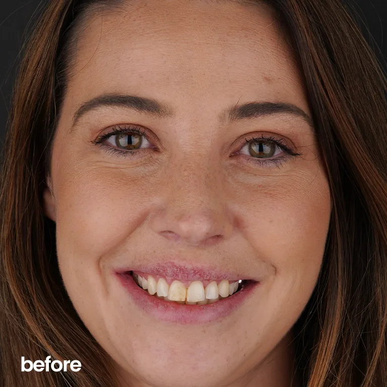 Hollywood Smile with Veneers A Perfect Combination