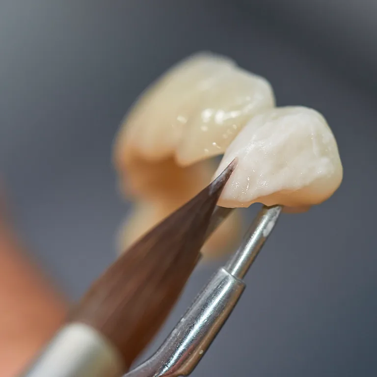 What to Do If Your Dental Crown Falls Off