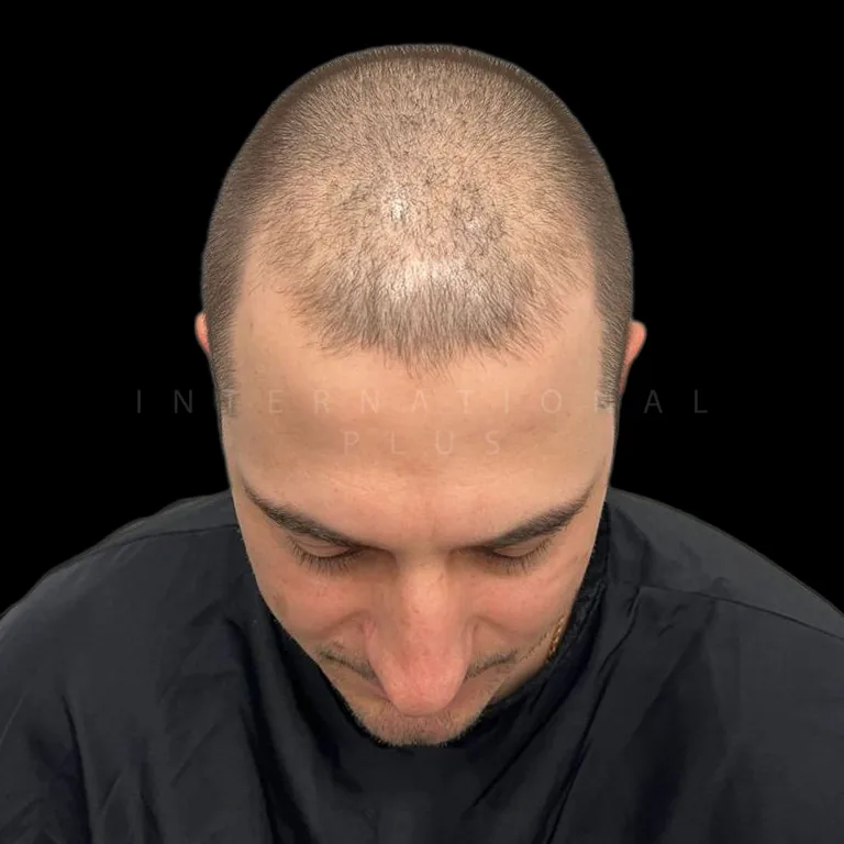 hair transplant before after 17