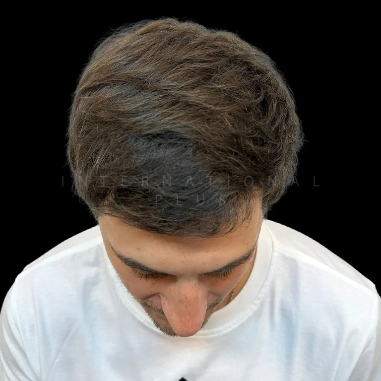 hair transplant before after 18