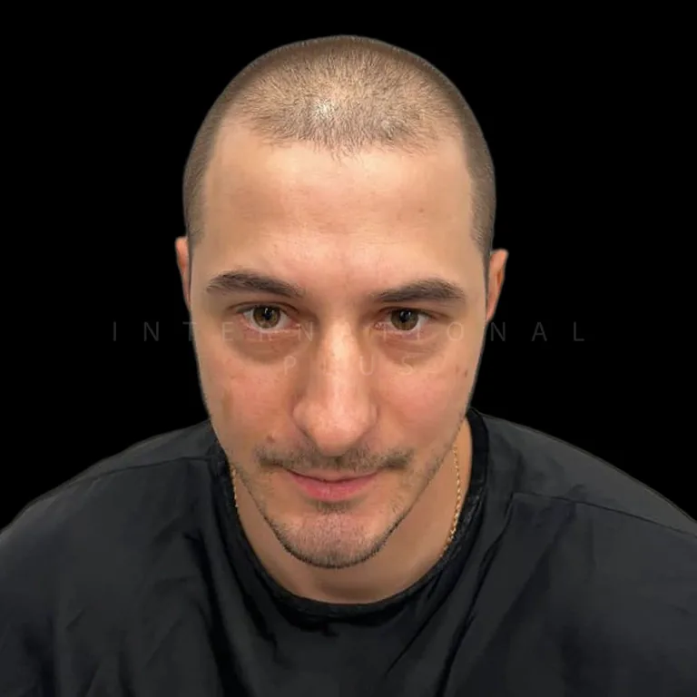 hair transplant before after 19