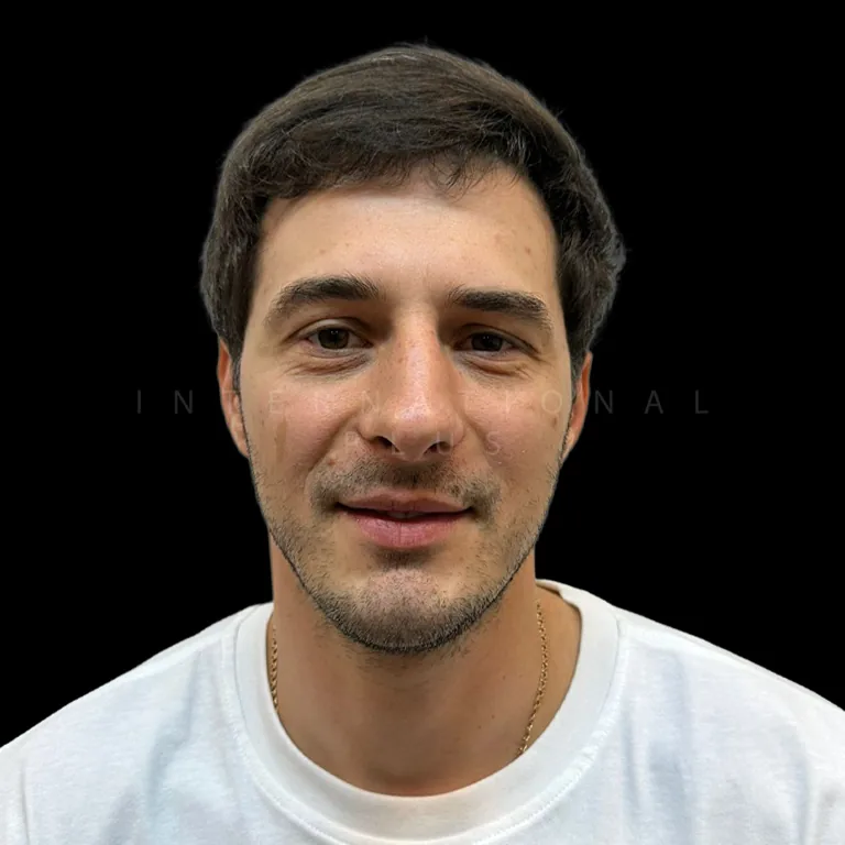 hair transplant before after 20