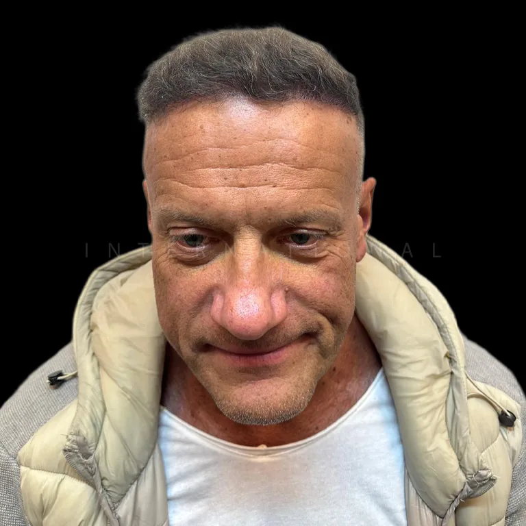 hair transplant before after 22