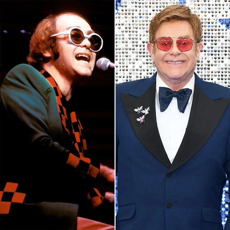 Elton John Hair Transplant Procedure
