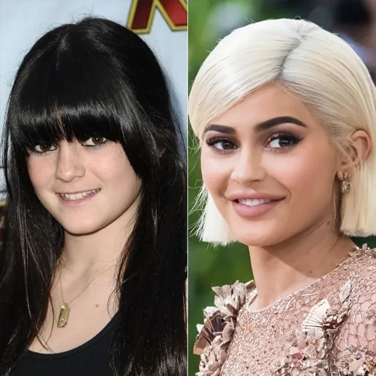Kylie Jenner Smile Before and After