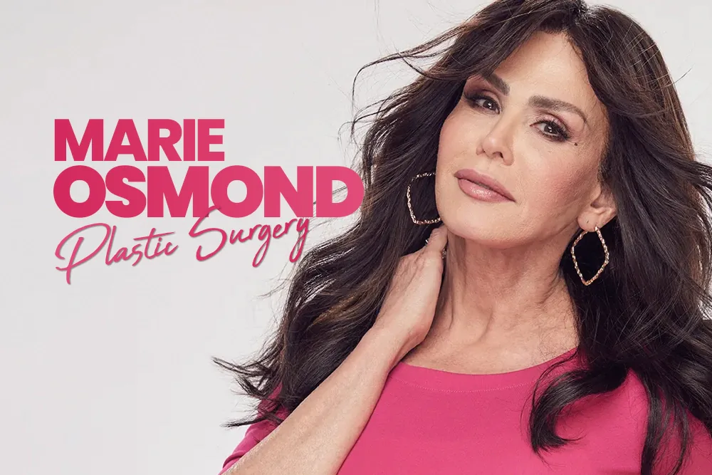 Marie Osmond Plastic Surgery