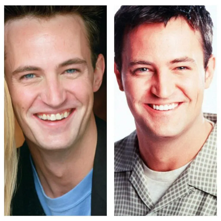 Matthew Perry Smile Before and After