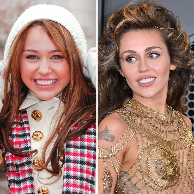 Miley Cyrus Smile Before and After