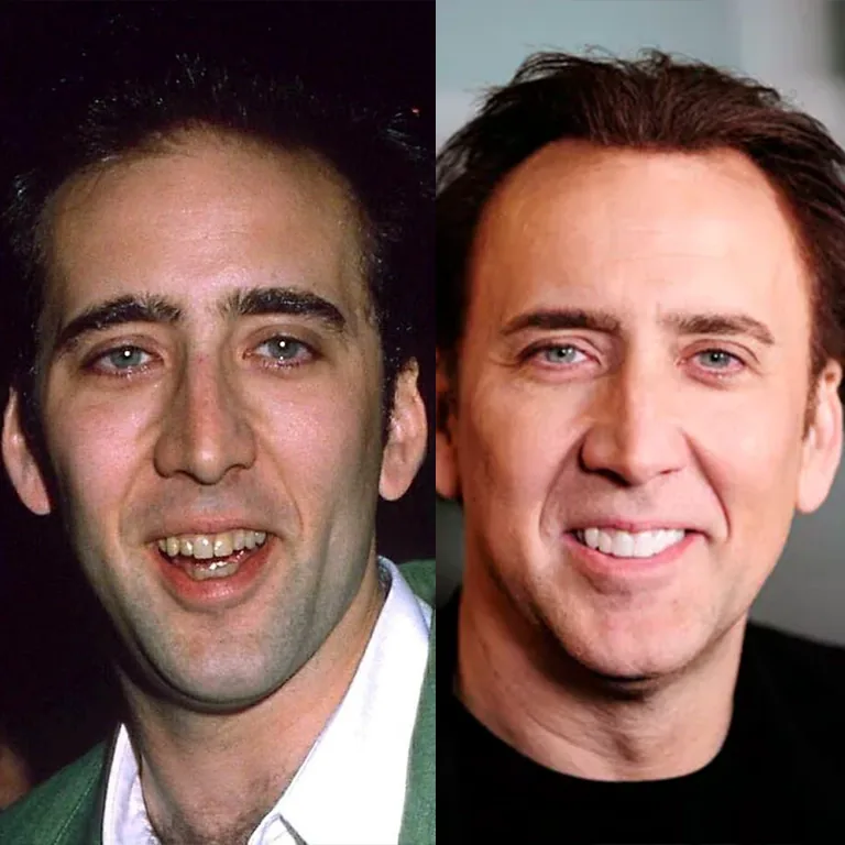 Nicolas Cage Before and After Veneers