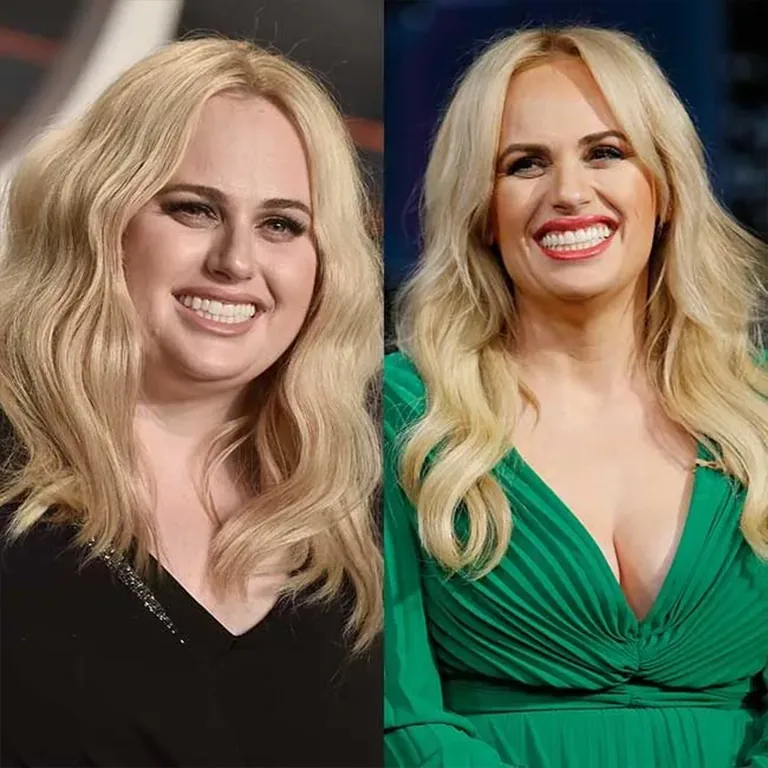 Rebel Wilson Smile Before and After