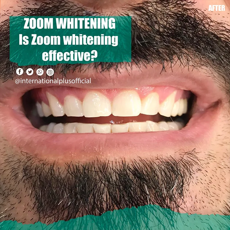 Professional Teeth Whitening vs Home Kits