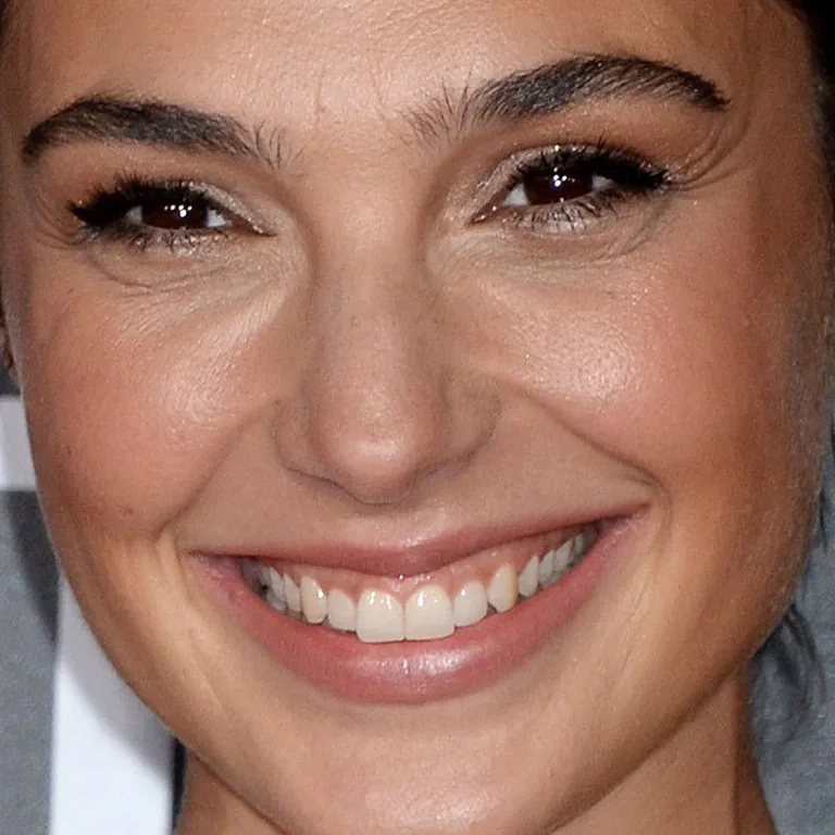 Achieving a Natural Hollywood Smile The Role of Veneers and Whitening