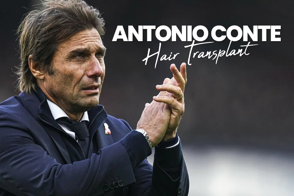 Antonio Conte Hair Transplant