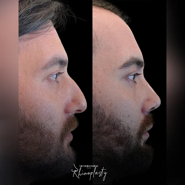 Finding the Right Surgeon for a Rhinoplasty