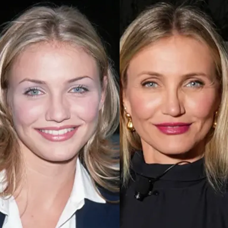How to Get a Natural Rhinoplasty