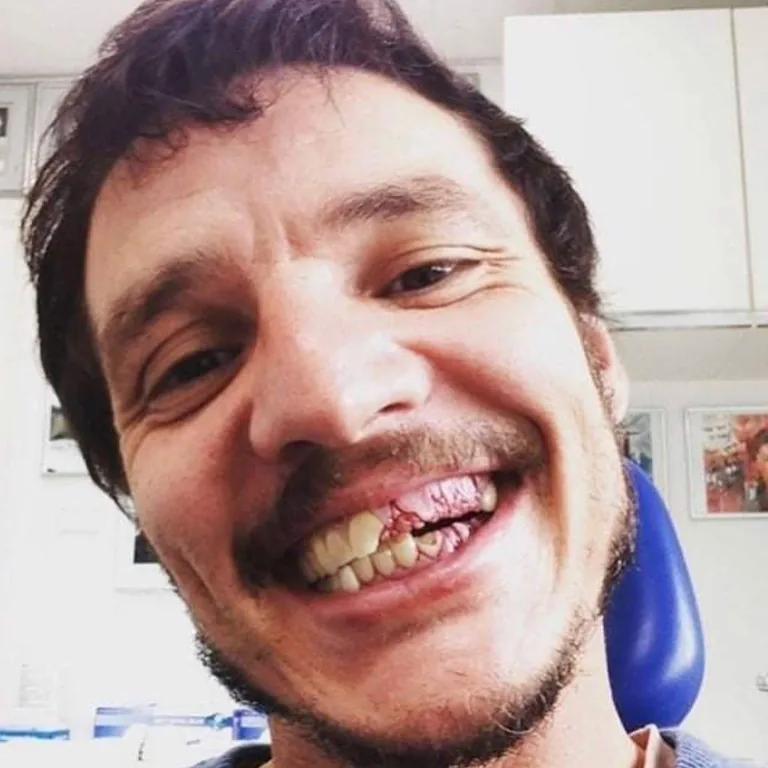 Is Pedro Pascal's Smile Natural