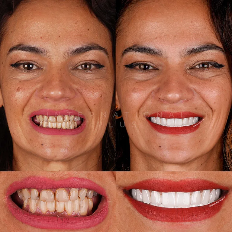 Our Approach to Creating Powerful, Natural Smiles