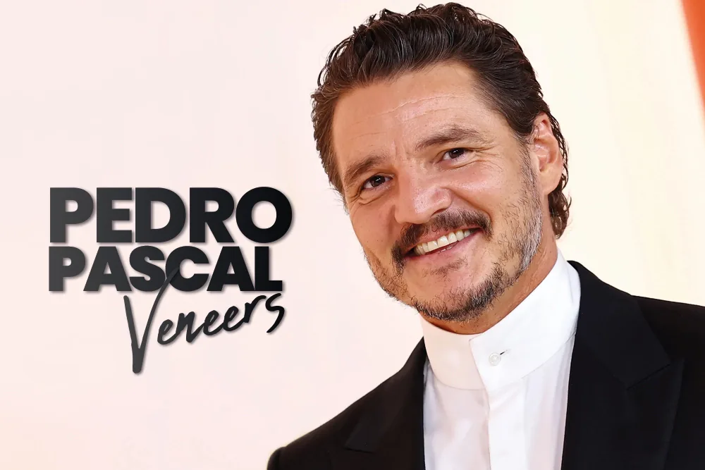 Pedro Pascal Veneers