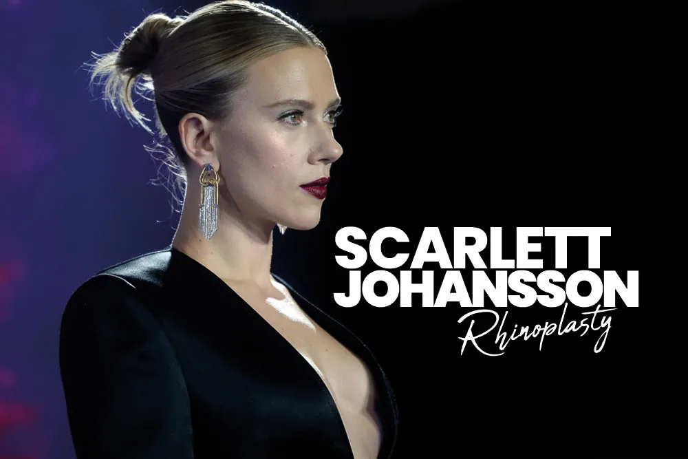 Scarlett Johansson Rhinoplasty
