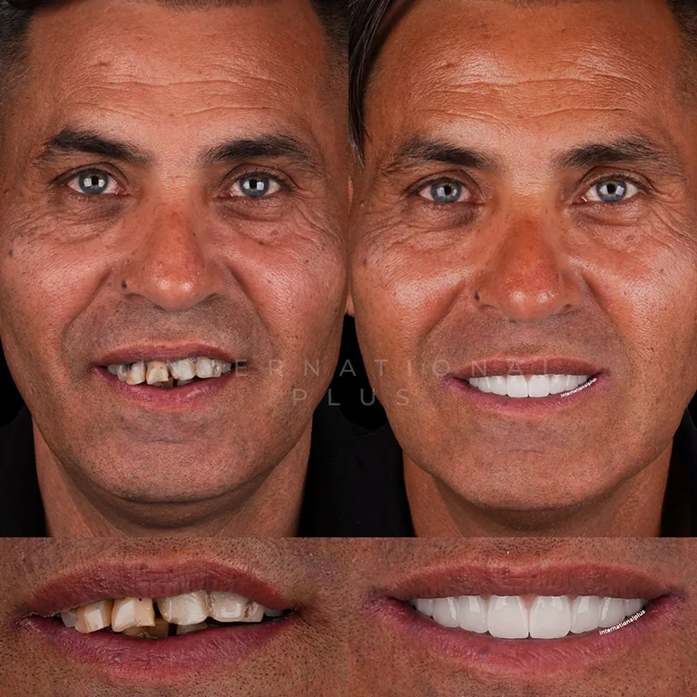 The Benefits of a Smile Transformation