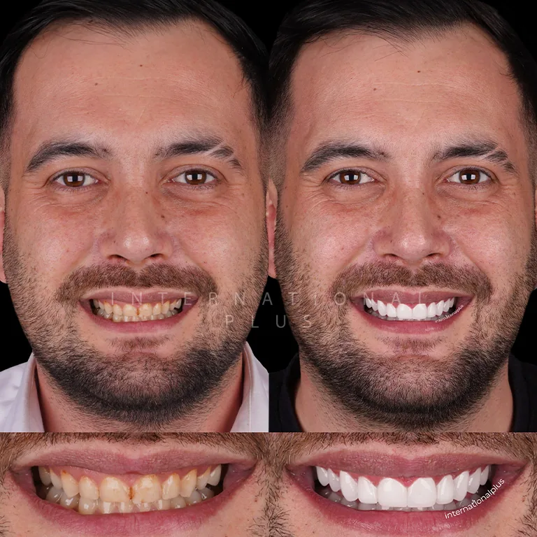 /sergio-ramos-rhinoplasty/