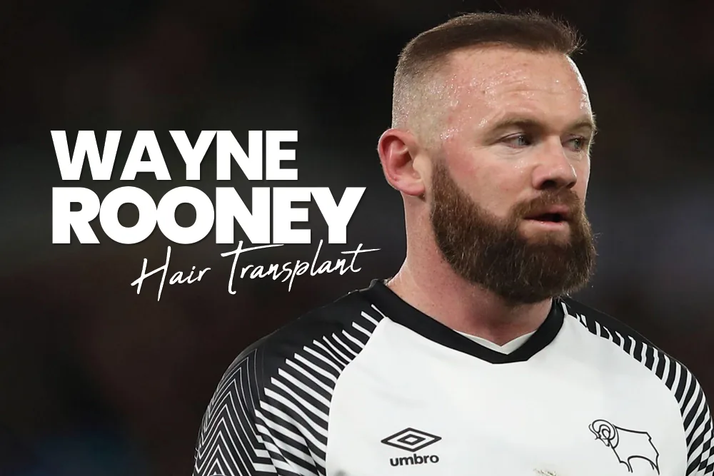 Wayne Rooney Hair Transplant