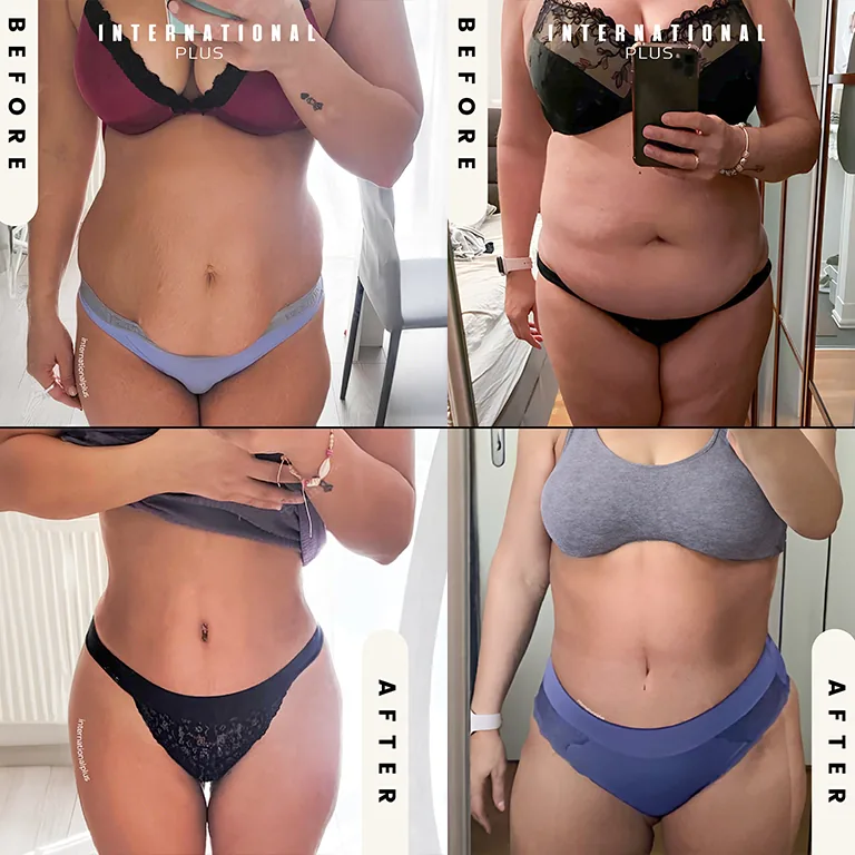 360 Lipo Before and After